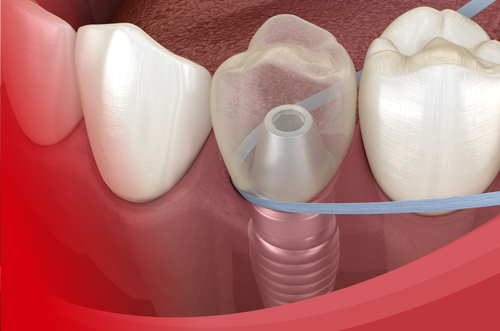 Plaque Control & Interdental Aids for Peri-Implantitis Prevention