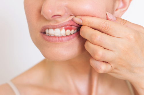 Beyond the Gums: The Systemic Impact of Periodontitis