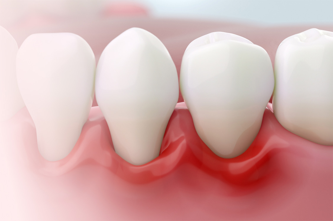 Managing Periodontal Risk Through Smarter Home-Care Protocols