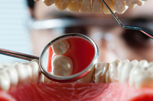 Navigating Endo-Perio Lesions: Simplified Solutions for Your Practise