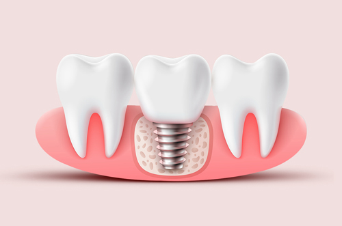 Implant Pitfalls: Understanding what can go wrong!