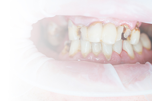 Managing the High-Risk Caries Patient: A Brief Clinical Guide