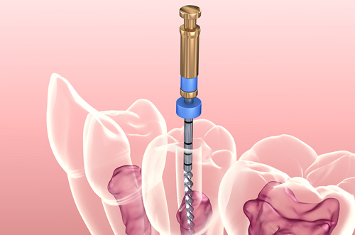Navigating the Hurdles of Endodontic Re-treatment